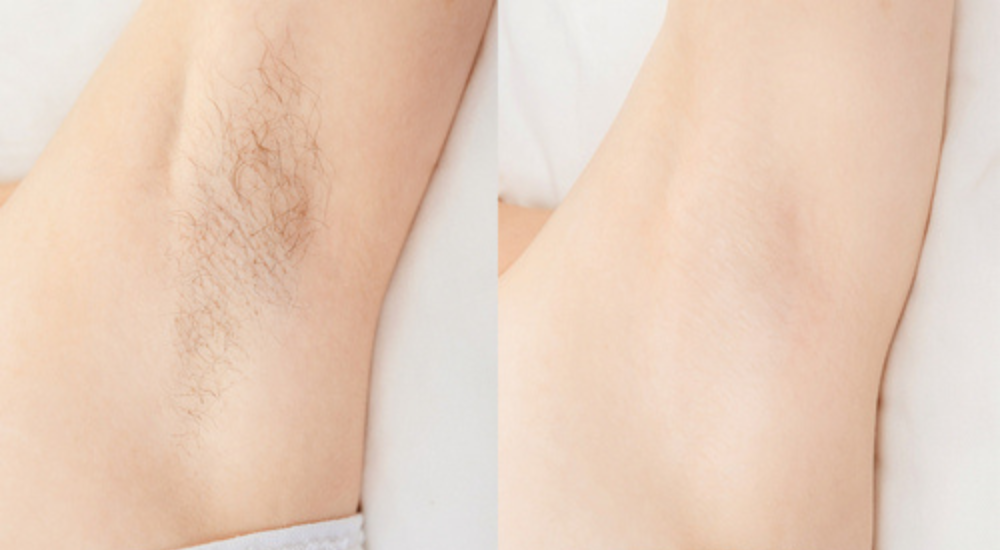 Mezoterápia _ Peeling _ Kozmetika