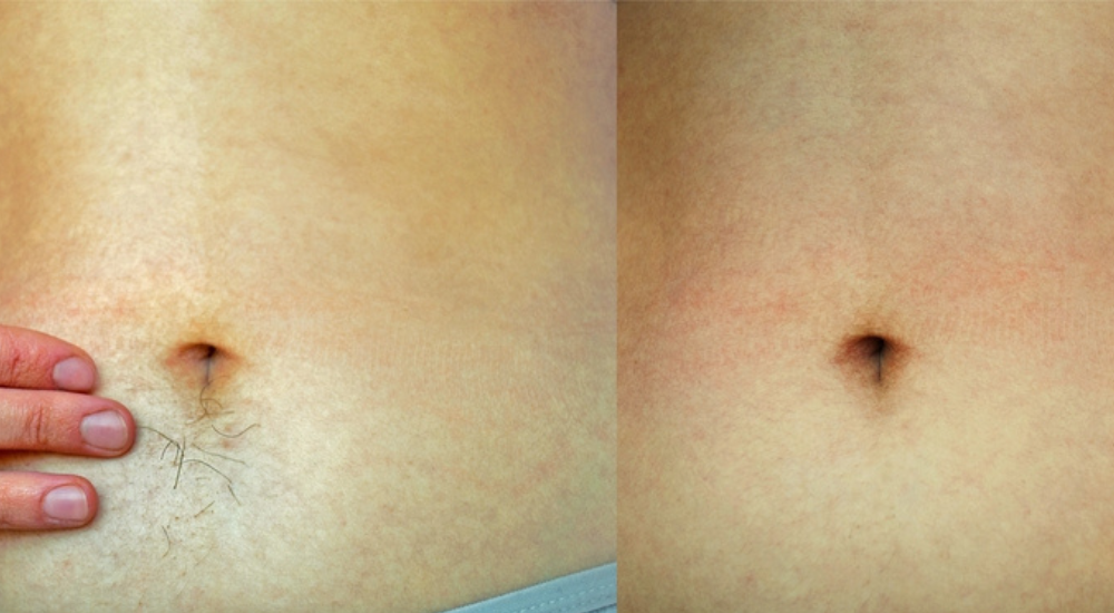 Mezoterápia _ Peeling _ Kozmetika