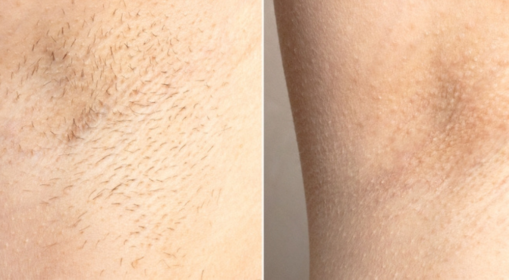 Mezoterápia _ Peeling _ Kozmetika