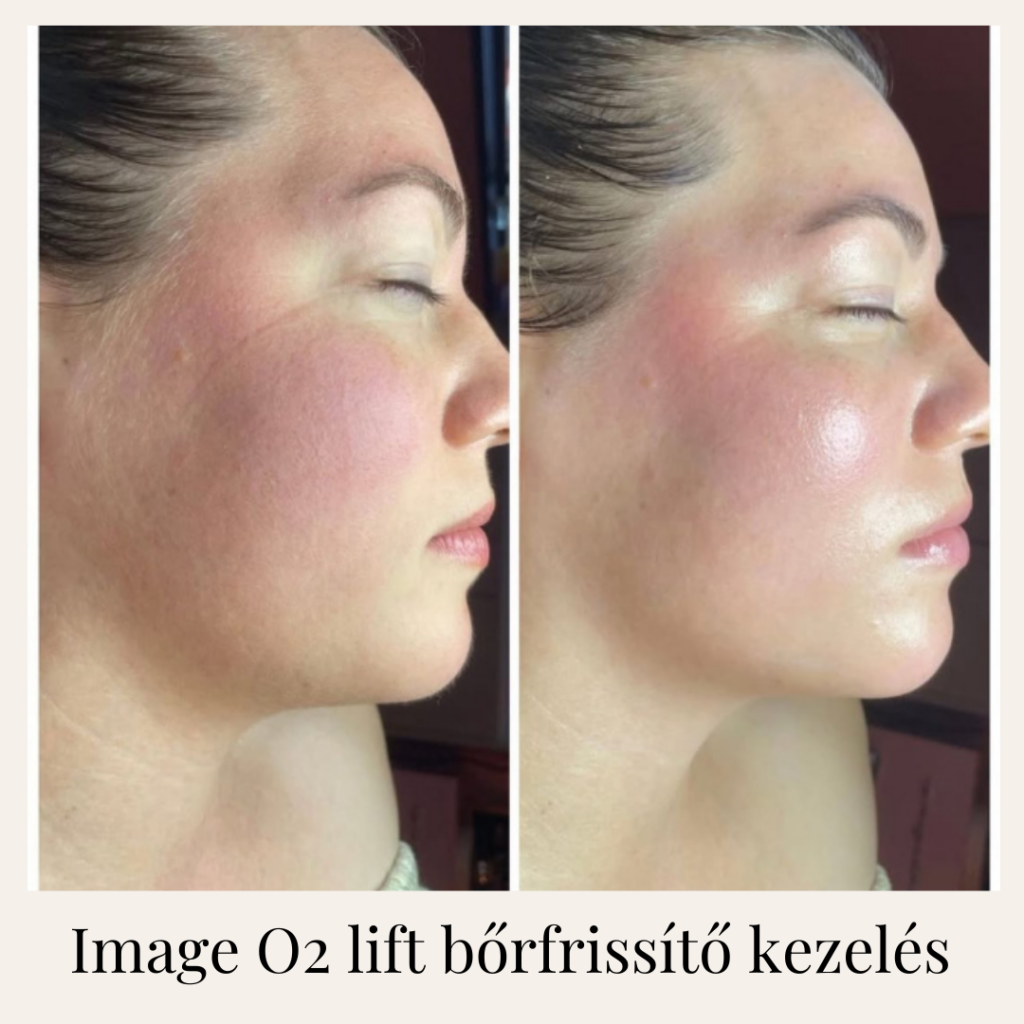 Image o2 lift